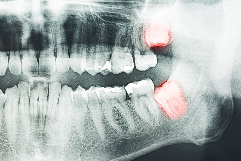 Dental X-Ray