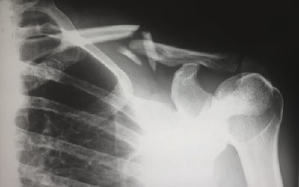 An X-ray showing a broken bone